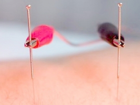 Elettroagopuntura in Chirurgia - Studio Medico Cirolla